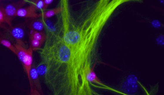 A melanoma-astrocyte interaction.