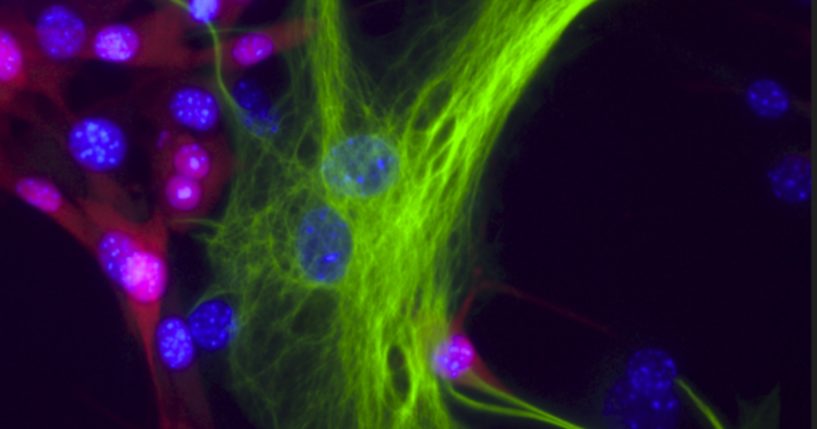 A melanoma-astrocyte interaction.