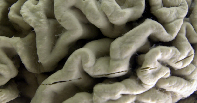 This 2003 file photo shows a closeup of a human brain affected by Alzheimer's disease. The photo is on display at the Museum of Neuroanatomy at the University at Buffalo.