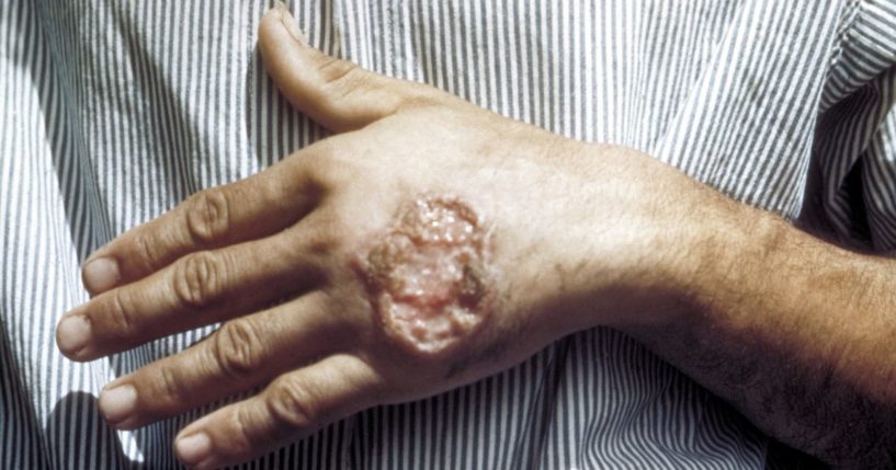 Skin ulcer due to leishmaniasis, on the hand of a Central American man.