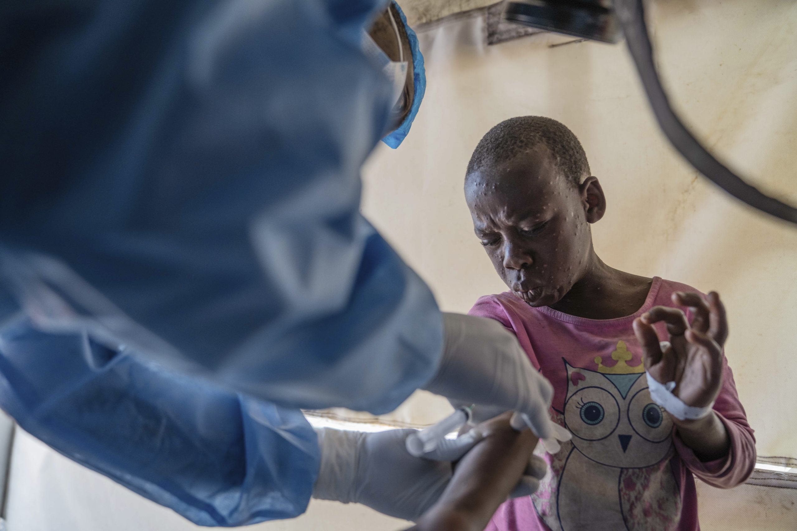 A health worker attends to a Mpox patient, at a treatment centre in Munigi, eastern Congo on Monday. Congo will receive the first vaccine doses to address its Mpox outbreak next week from the United States, the country's health minister said Monday, days after the World Health Organization declared Mpox outbreaks in Africa a global emergency.