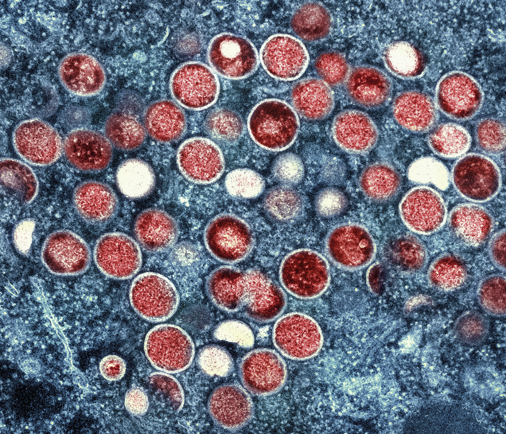 This undated image provided by the National Institute of Allergy and Infectious Diseases shows a colorized transmission electron micrograph of monkeypox particles (red) found within an infected cell (blue), cultured in the laboratory that was captured and color-enhanced at the NIAID Integrated Research Facility in Fort Detrick, Md.