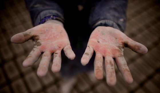 An Afghan child shows their chapped hands at the Sadat Ltd. Brick factory, where some children work from 8 am to 5 pm daily, on May 14, 2010 in Kabul, Afghanistan. Child labour is common at the brick factories where the parents work as labourers, desperate to make more money enlisting their children to help doing the easy jobs. Brick factories are an economical, business that is still thriving. The land used is dry and barren which is perfect for the making of bricks providing work almost all the year round. A few years ago all factories changed from wood to coal causing further problems with pollution. The factories have been pushed out of the city limits because of this issue. Workers can make an average of USD 200 to 300 per month. For 1,000 bricks the factory will get about USD 45.