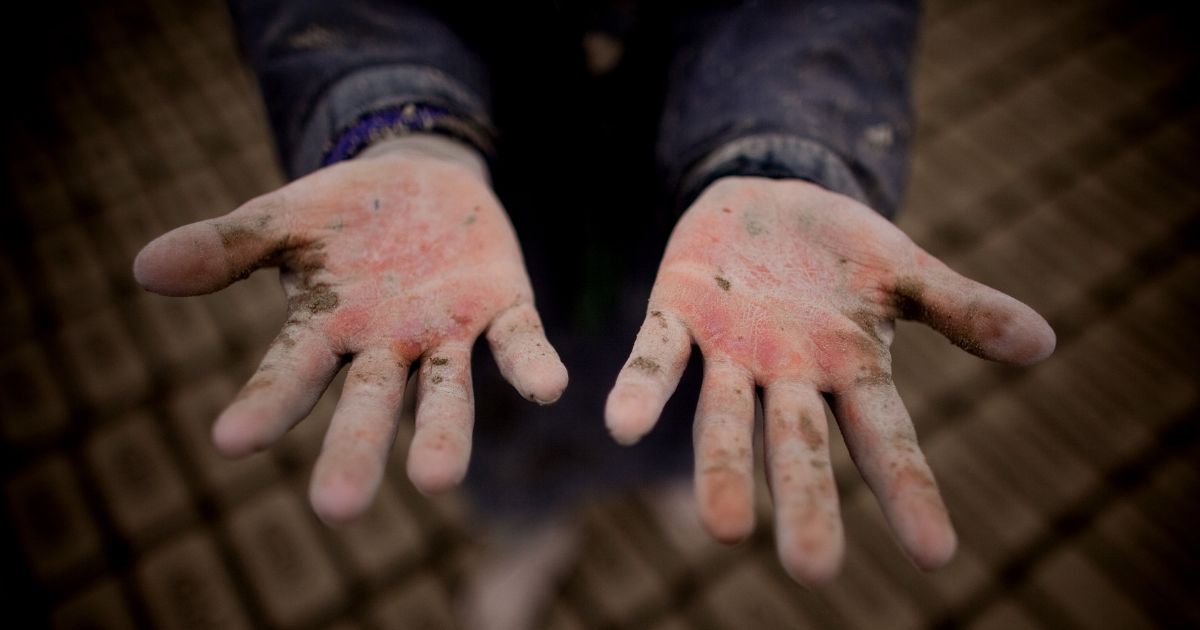 An Afghan child shows their chapped hands at the Sadat Ltd. Brick factory, where some children work from 8 am to 5 pm daily, on May 14, 2010 in Kabul, Afghanistan. Child labour is common at the brick factories where the parents work as labourers, desperate to make more money enlisting their children to help doing the easy jobs. Brick factories are an economical, business that is still thriving. The land used is dry and barren which is perfect for the making of bricks providing work almost all the year round. A few years ago all factories changed from wood to coal causing further problems with pollution. The factories have been pushed out of the city limits because of this issue. Workers can make an average of USD 200 to 300 per month. For 1,000 bricks the factory will get about USD 45.