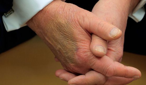 A large bruise is seen on the right hand of President Donald Trump as he meets with French President Emmanuel Macron on Monday.