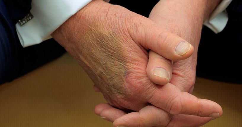 A large bruise is seen on the right hand of President Donald Trump as he meets with French President Emmanuel Macron on Monday.