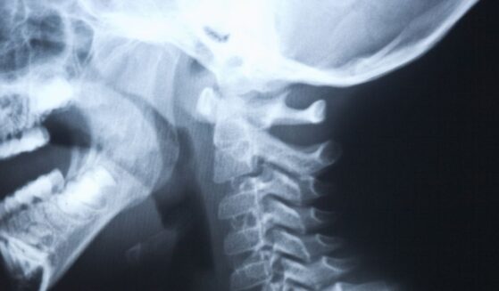 Detail from a head and next x-ray.