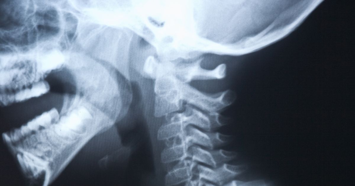Woman’s Skull Nearly Slid Off Spine as Internal ‘Decapitation’ Threatened to Suddenly End Her Life